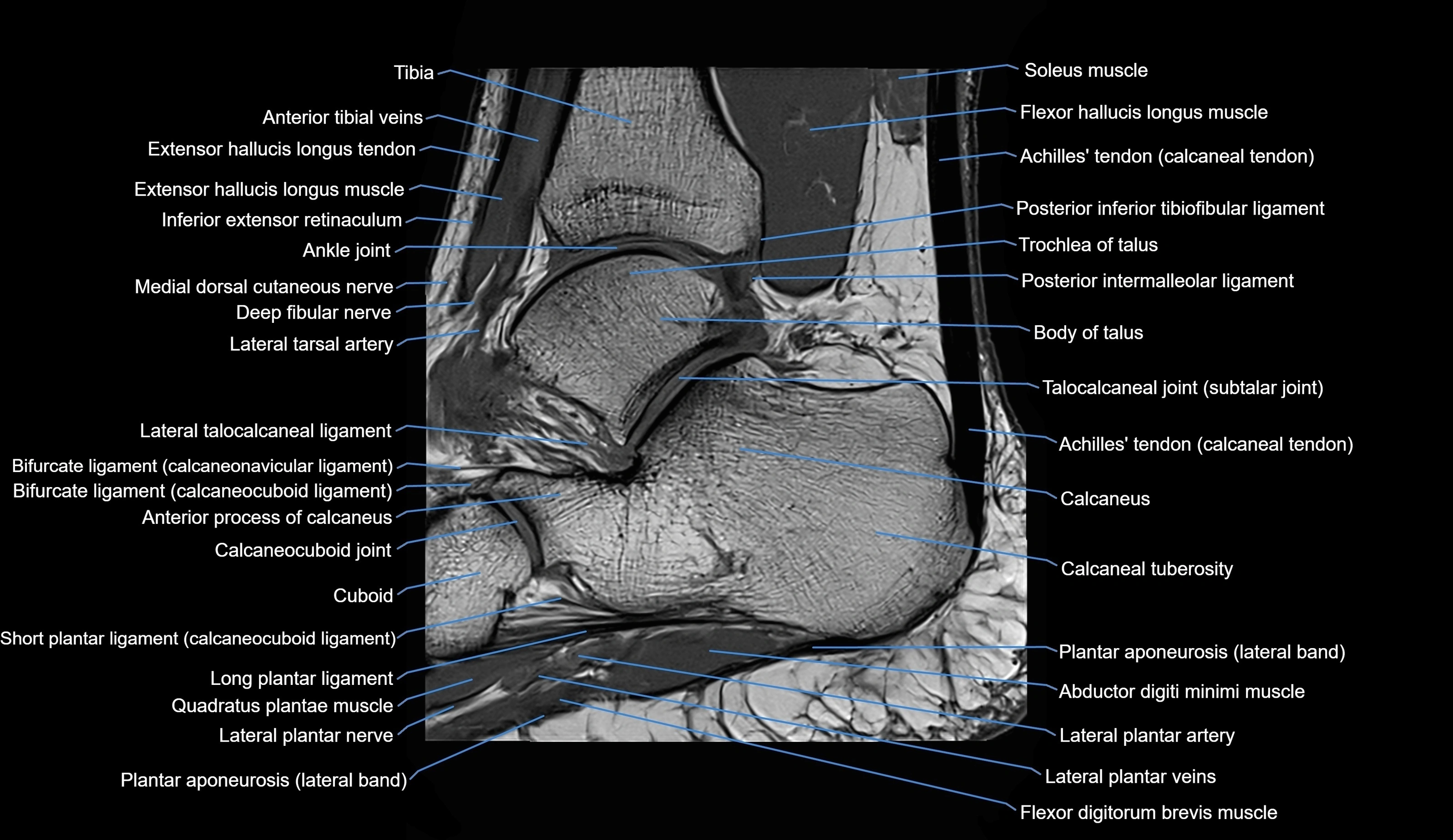 MRI Ankle sagittal cross sectional anatomy 3T  radiology  image-img-00001-00021.webp